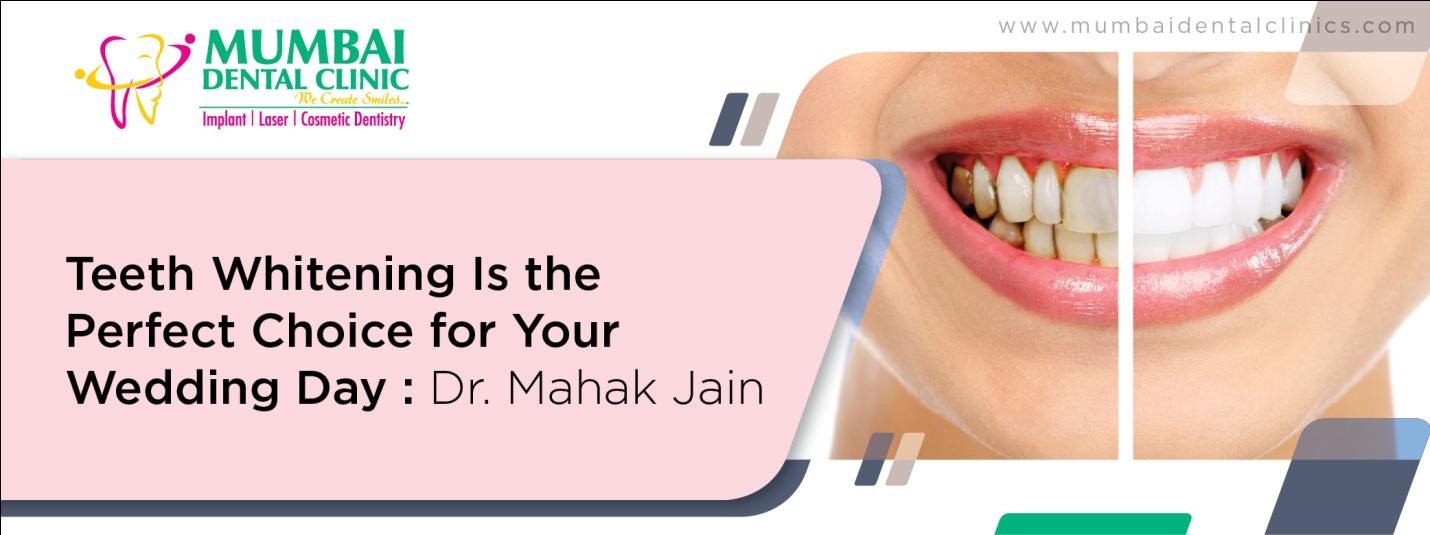 Teeth Whitening Is the Perfect Choice for Your Wedding Day : Dr. Mahak Jain